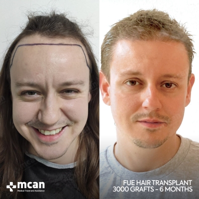 Actual MCAN Health patient: 3000 Grafts FUE Hair Transplant — 6 Months Result