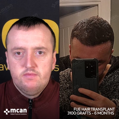 Actual MCAN Health patient: 3100 Grafts FUE Hair Transplant — 6 Months Result