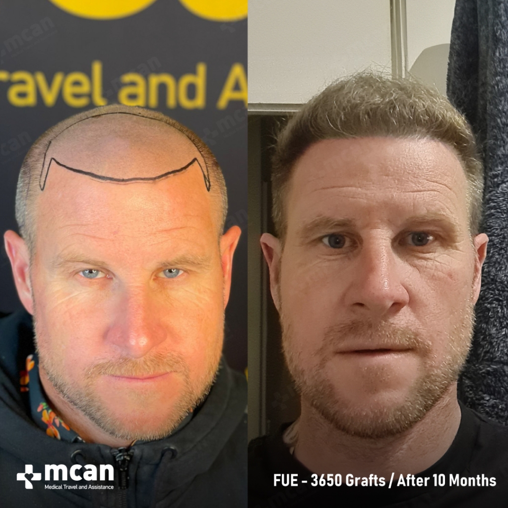 FUE HAIR TRANSPLANT BEFORE AND AFTER 3650 GRAFTS 3