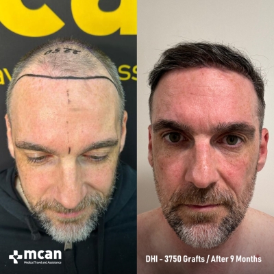 Actual MCAN Health patient: 3750 Grafts FUE Hair Transplant — 9 Months Result