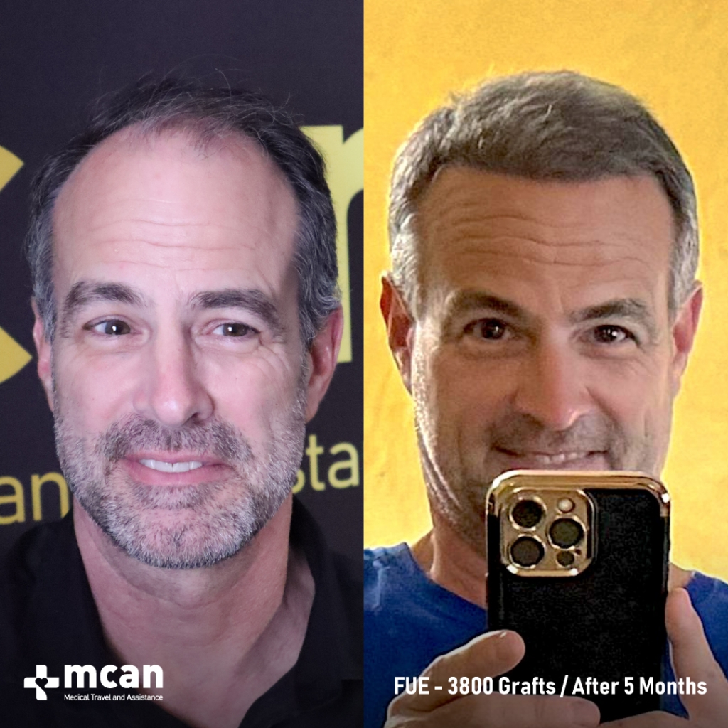 FUE HAIR TRANSPLANT BEFORE AND AFTER 3800 GRAFTS 17