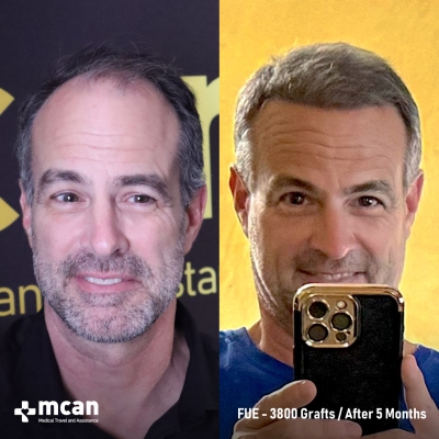 Actual MCAN Health patient: 3800 Grafts FUE Hair Transplant — 5 Months Result