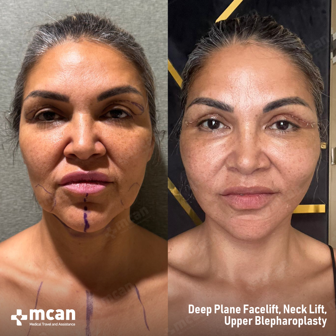 EYELID SURGERY TURKEY