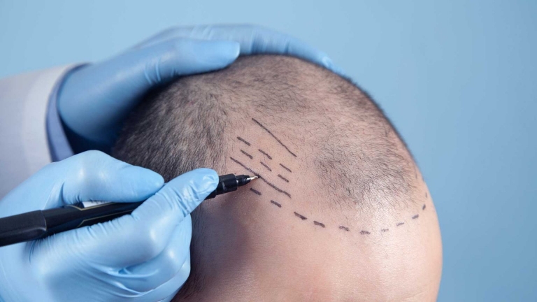 How Long Does a Hair Transplant Last? 11 how long does a hair transplant last how long does a hair transplant last