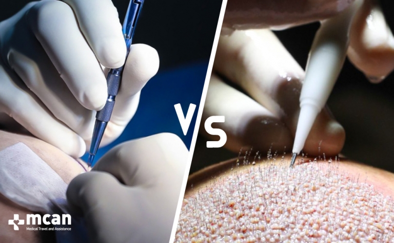 DHI vs. FUE: Hair Transplant Procedures Compared 10 FUE VS DHI FUE VS DHI