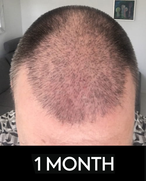 Haartransplantation Zeitplan: Ein Leitfaden für Heilung und Haarwachstum 6 1 MONTH 1 1 MONTH 1
