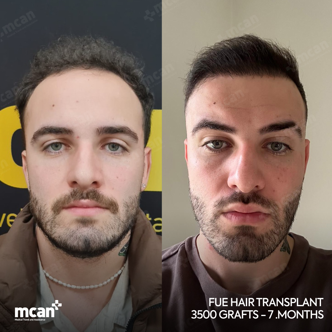 FUE Hair Transplant Turkey | MCAN Health
