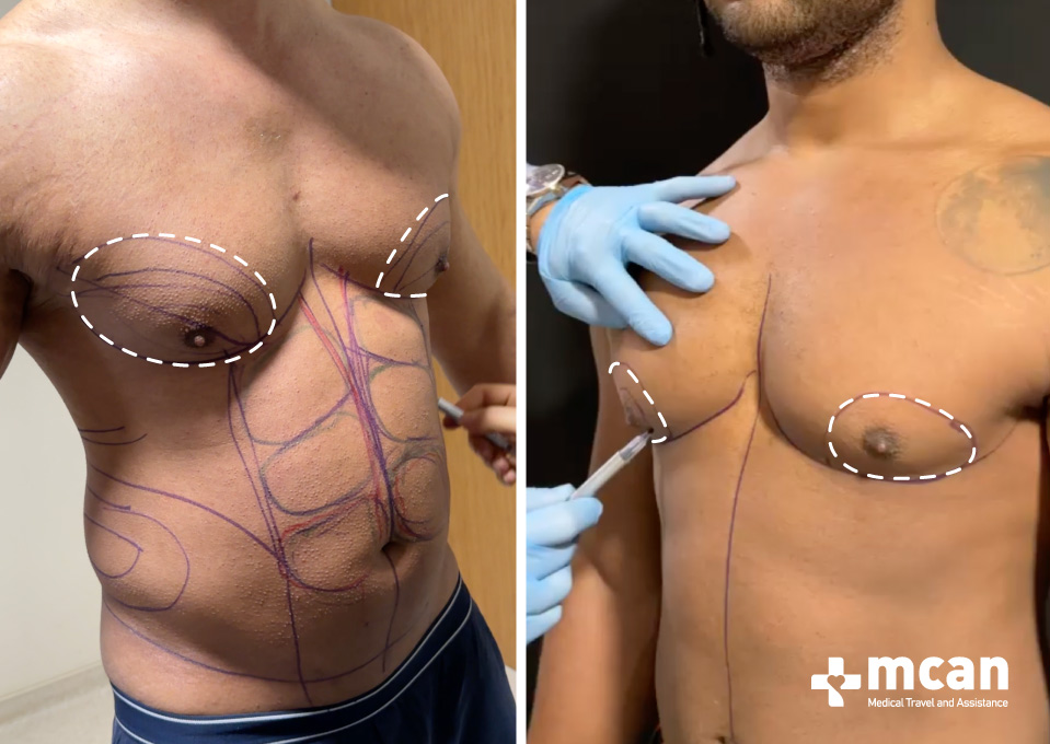 Gynecomastia vs. Chest Fat: A Clear-Cut Guide to Understanding Your Chest 2 Gynecomastia Gynecomastia