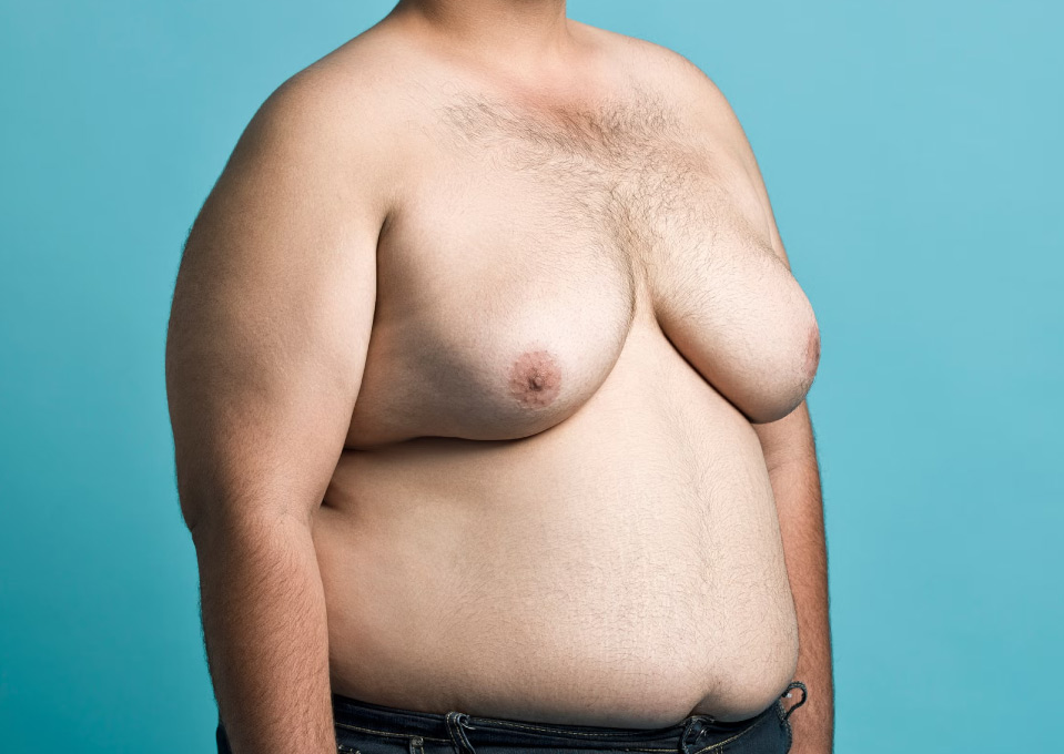 Gynecomastia vs. Chest Fat: A Clear-Cut Guide to Understanding Your Chest 3 fat chest fat chest