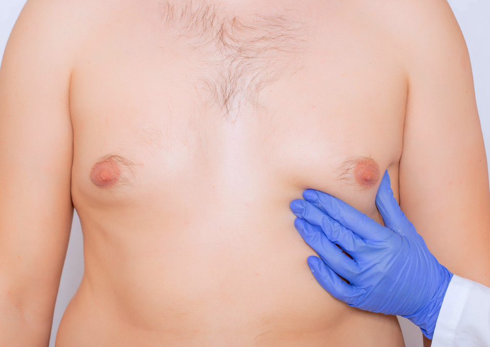 Gynecomastia vs. Chest Fat: A Clear-Cut Guide to Understanding Your Chest 4 pinch test pinch test