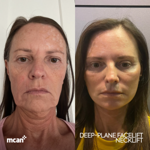 Facelift Result in Turkey Before After 1