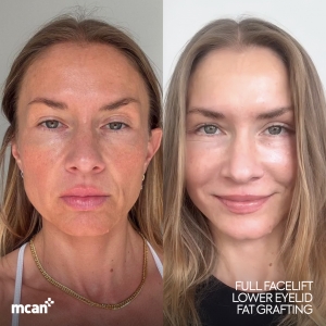 Facelift Result in Turkey Before After 2