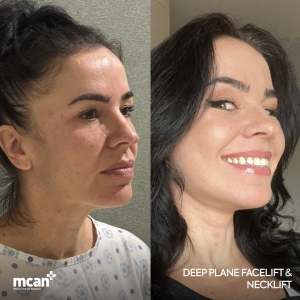 Facelift Result in Turkey Before After 3