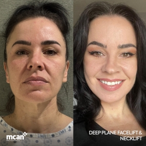 Facelift Result in Turkey Before After 4