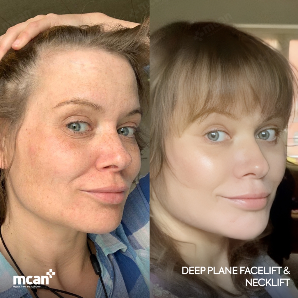 Lifting deep plane vs. SMAS: ¿qué técnica es la adecuada para usted? 4 Facelift Result in Turkey Before After 5 Facelift Result in Turkey Before After 5