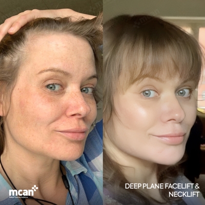 Actual MCAN Health patient: Facelift Result - Photo 2