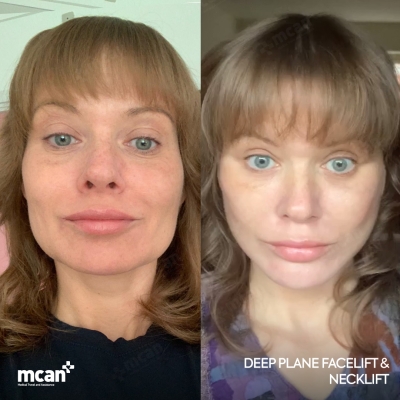 Actual MCAN Health patient: Facelift Result