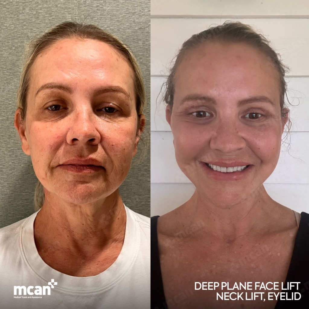 Lifting deep plane vs. SMAS: ¿qué técnica es la adecuada para usted? 3 Facelift Result in Turkey Before After 7 Facelift Result in Turkey Before After 7