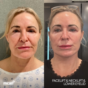 Facelift Result in Turkey Before After 8