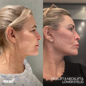 Facelift Result in Turkey Before After 9