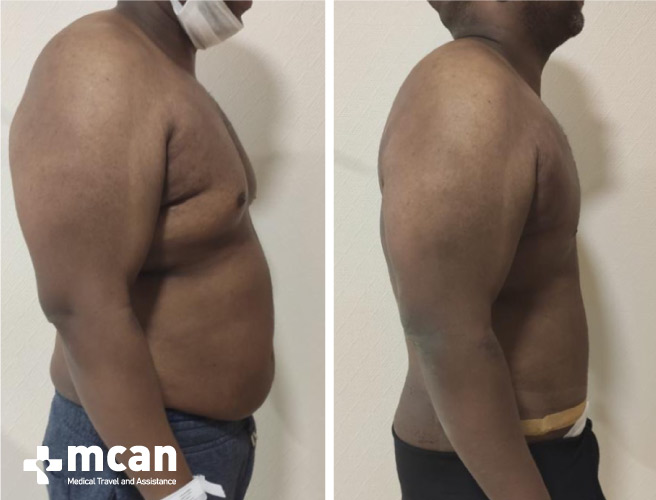 Gynecomastia Surgery Results Before After 3