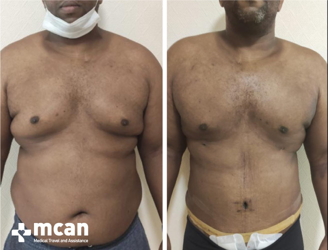 Gynecomastia Surgery Results Before After 5