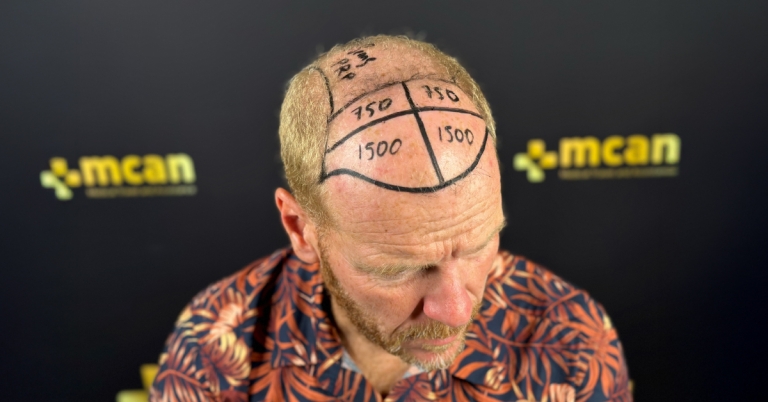 Cantidad de foliculos para el injerto capilar: cómo saber el número adecuado para ti 7 Hair Transplant Graft Counts Cover Hair Transplant Graft Counts Cover