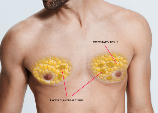 What is Gynecomastia Surgery