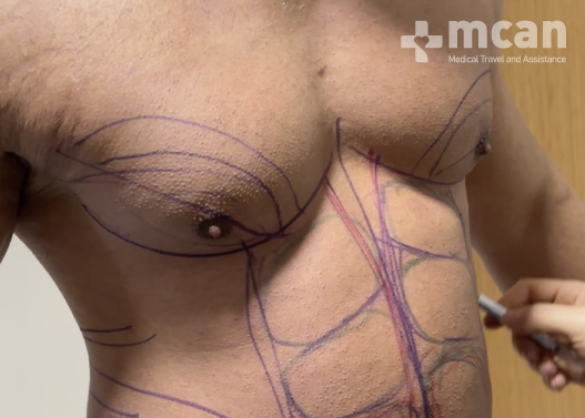 Who Is Suitable for Gynecomastia Surgery