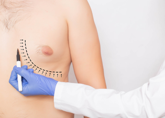 Why Should You Get Gynecomastia Surgery in Turkey