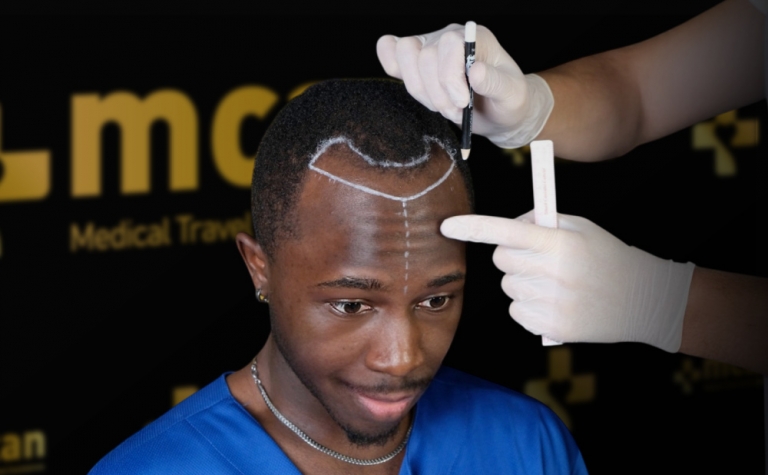 Afro Hair Transplant Explained