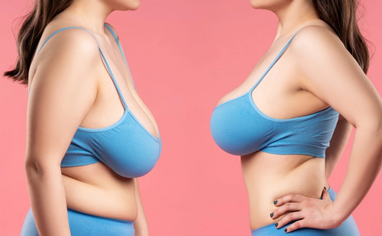 Do You Need a Breast Lift, Breast Reduction or Both? 4 Do You Need a Breast Lift Breast Reduction or Both Do You Need a Breast Lift Breast Reduction or Both