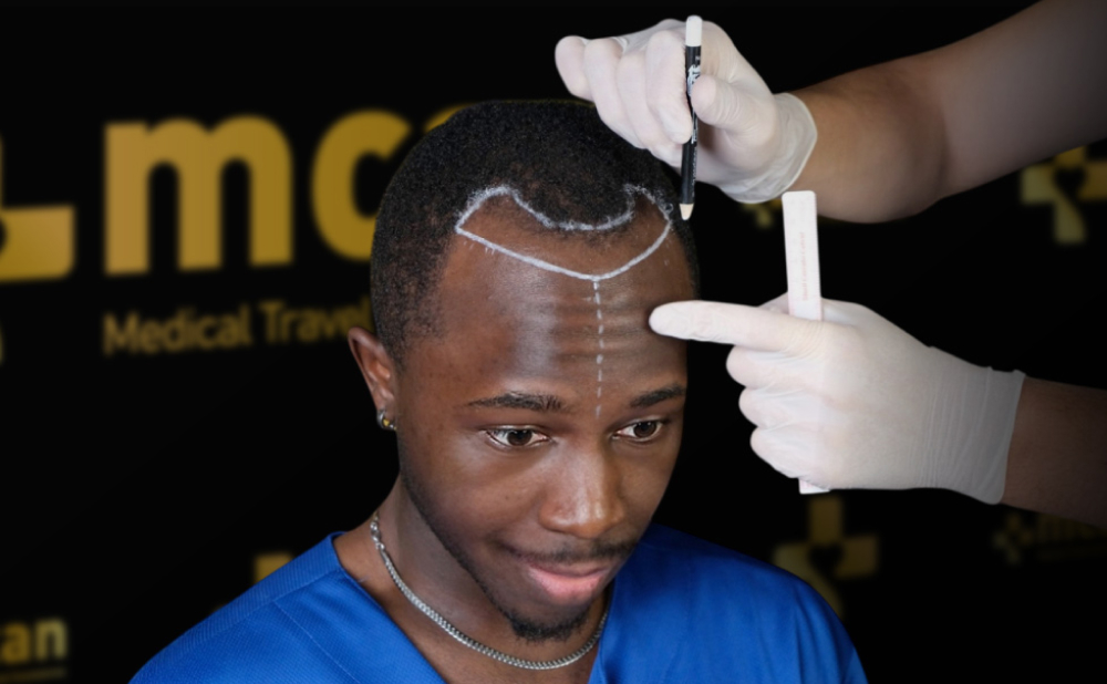 Hair Transplant Swelling: Causes and Care Tips 3 Can Swelling Affect My Hairline Appearance Can Swelling Affect My Hairline Appearance