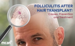 Cover Photo of Folliculitis After Hair Transplant: Causes, Prevention, and Treatment