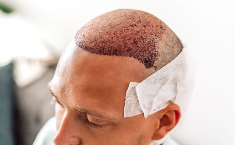 Trasplante capilar sin agujas 51 Hair Transplant Scabs Costras Del Trasplante Capilar: Calendario Semanal