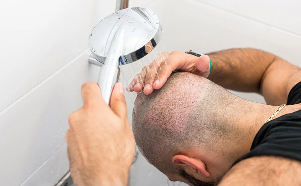 Hair Transplant Swelling: Causes and Care Tips 4 Preventing Severe Swelling What You Can Do Before and After Surgery Preventing Severe Swelling What You Can Do Before and After Surgery