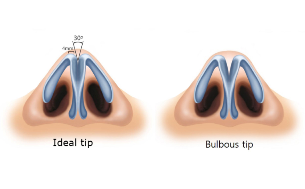 Approaching Bulbous Tip Correction in Thick Skinned Noses