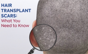 Cover Hair Transplant Scars