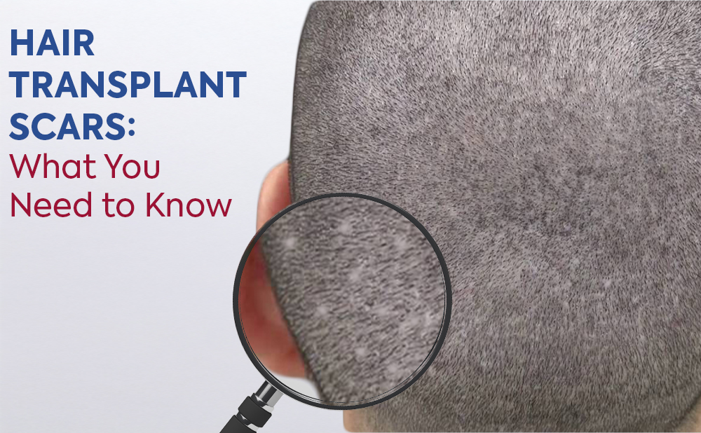 Hair Transplant Scars: What You Need to Know 1 Cover Hair Transplant Scars Cover Hair Transplant Scars