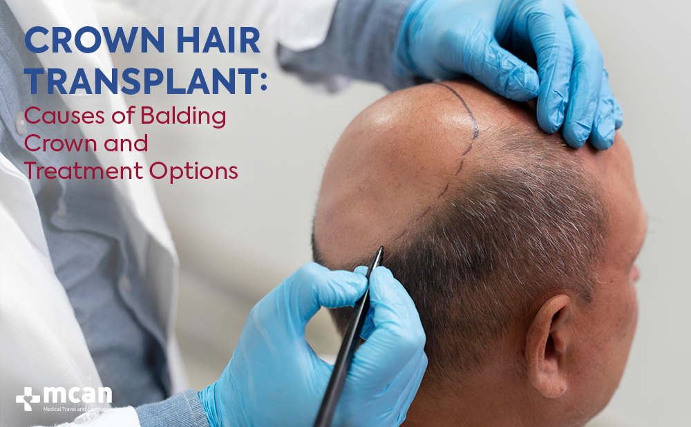 Crown Hair Transplant: Causes of Balding Crown and Treatment Options 1 Crown Hair Transplant Causes of Balding Crown and Treatment Options Crown Hair Transplant Causes of Balding Crown and Treatment Options