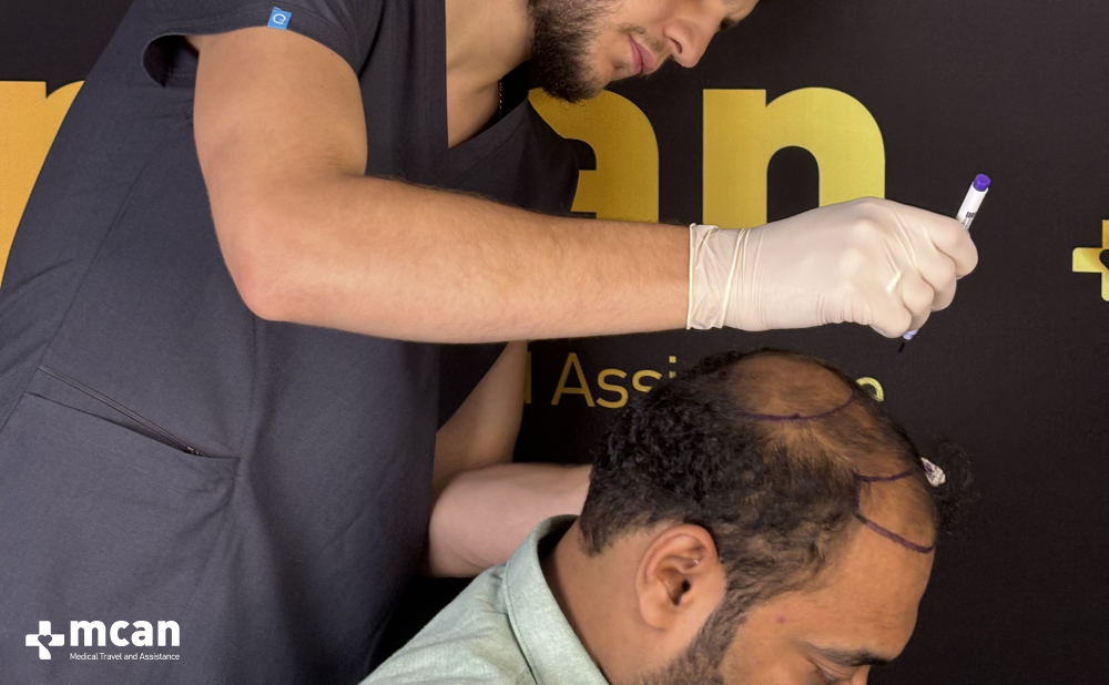 Crown Hair Transplant: Causes of Balding Crown and Treatment Options 6 Crown Hair Transplant Success Rate Crown Hair Transplant Success Rate