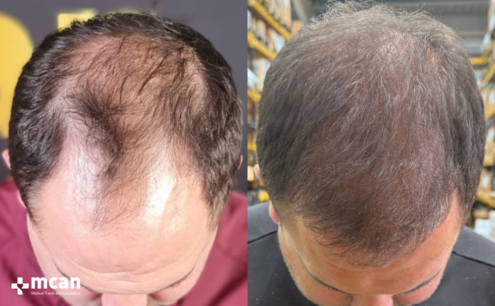 Crown Hair Transplant: Causes of Balding Crown and Treatment Options 5 Crown Hair Transplant as a Permanent Solution Crown Hair Transplant as a Permanent Solution