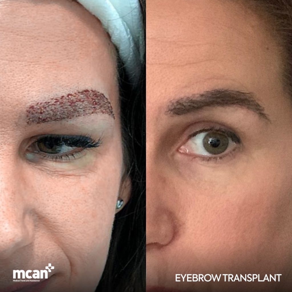 Eyebrow Transplant Before After 1