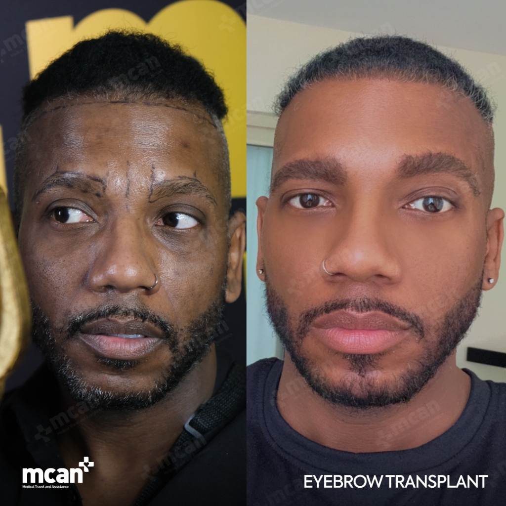 Eyebrow Transplant Before After 2