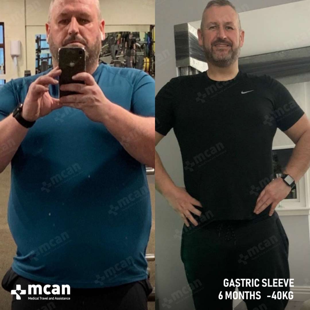 GASTRIC SLEEVE 12