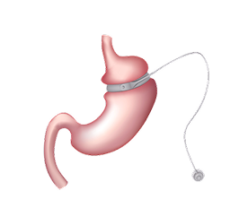Gastric Balloon