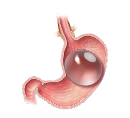 Gastric Bypass