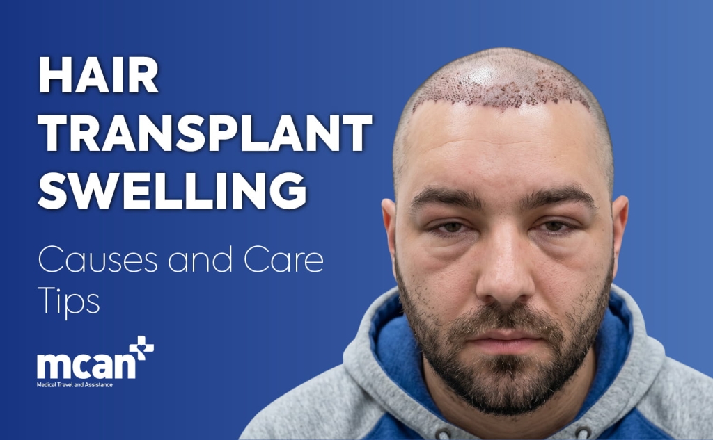 Hair Transplant Swelling: Causes and Care Tips 1 Hair Transplant Swelling en 1 Hair Transplant Swelling en 1