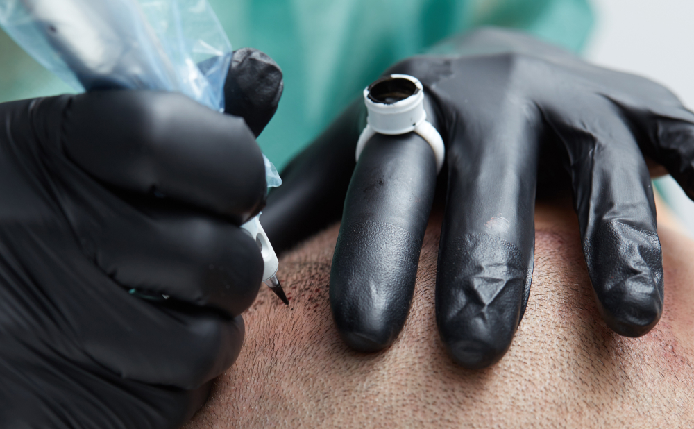 Hair Transplant Scars: What You Need to Know 5 How to Treat or Conceal Hair Transplant Scars How to Treat or Conceal Hair Transplant Scars