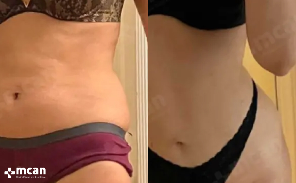 Love Handle Liposuction: Sculpting Your Waistline 5 Love Handle Liposuction in Turkey with MCAN Health Love Handle Liposuction in Turkey with MCAN Health